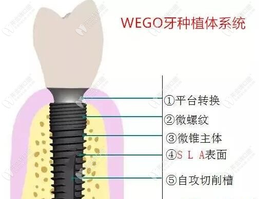 威高种植体特点