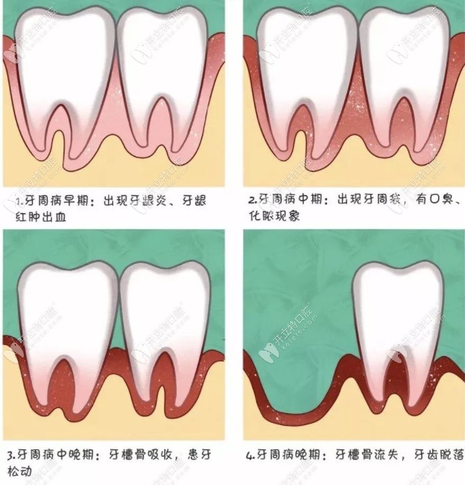 牙周病的发展过程