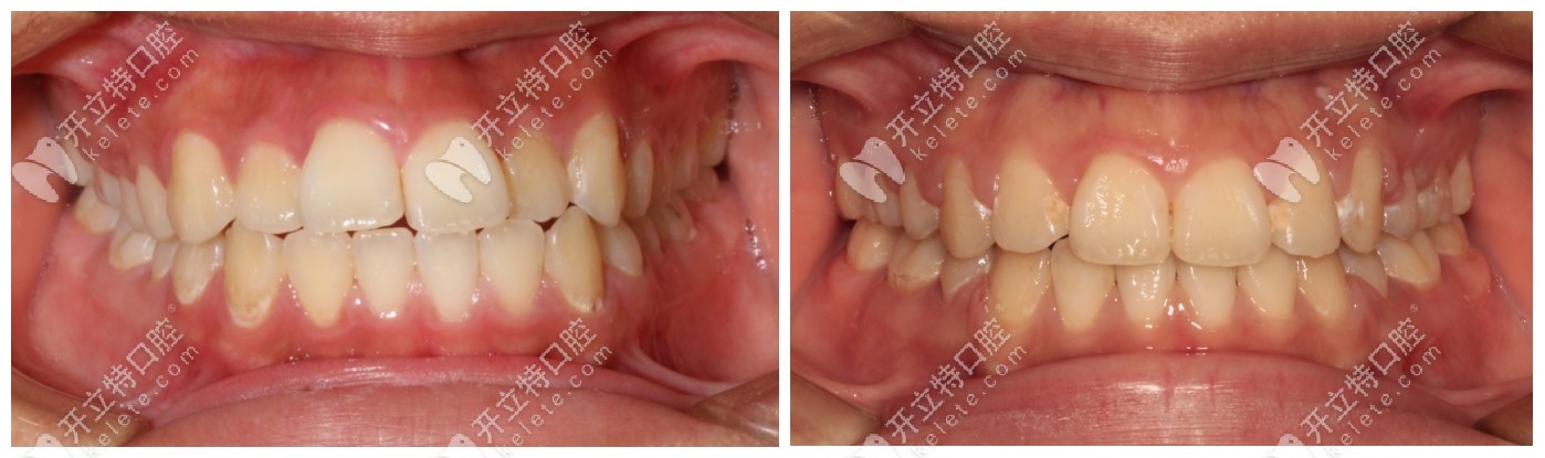 嘴凸矫正前后对比图