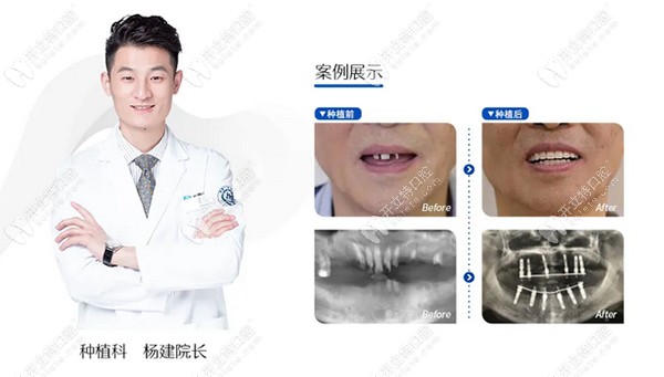 美奧口腔的種植科院長楊建