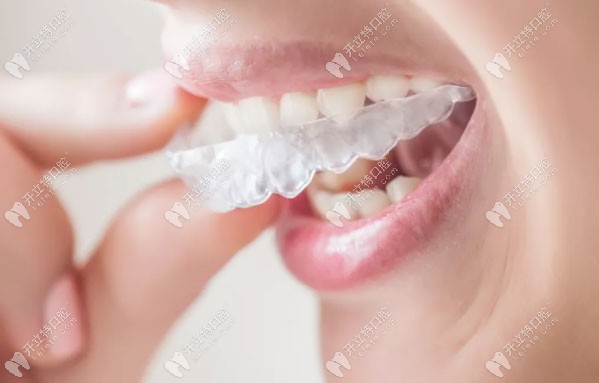 恒伦口腔的隐形牙套可免费试戴