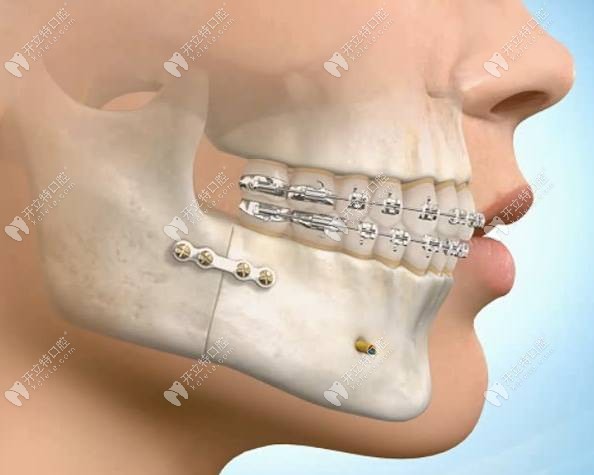 牙齿矫正图示