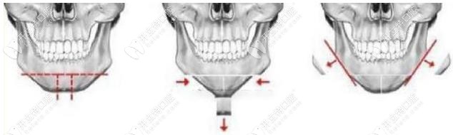 頦成型術(shù)的手術(shù)過程