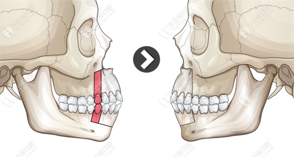 突嘴手术的截骨区域示意图