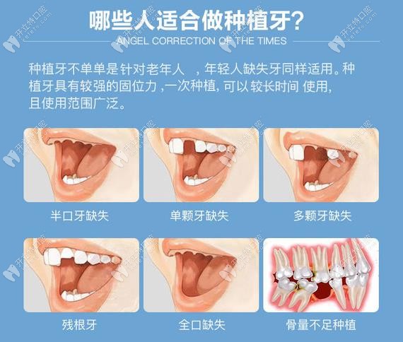 哪些人是比较适合在德阳新桥口腔做种植牙？