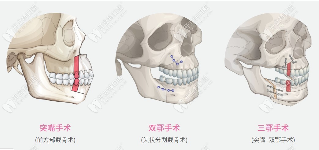 以下是正颌手术的三种手术方式，有简单到复杂