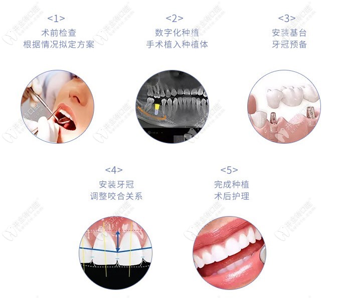 佳美口腔做种植牙的详细过程图解