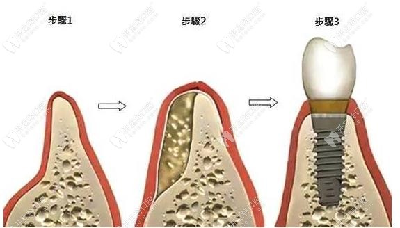 种植牙植骨粉过程