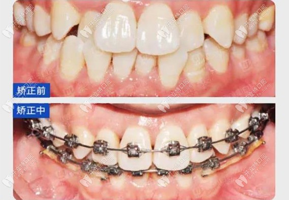 正畸前和正畸过程中的牙齿变化效果