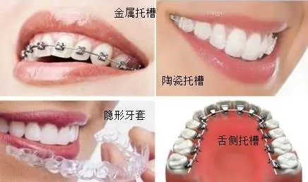 市面上几款常见牙套的对比