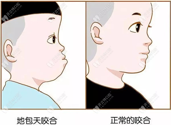兒童地包天面型和正常面型對比圖