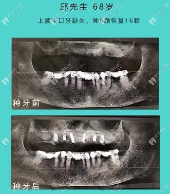 易医师——68岁上颌半口种植6颗