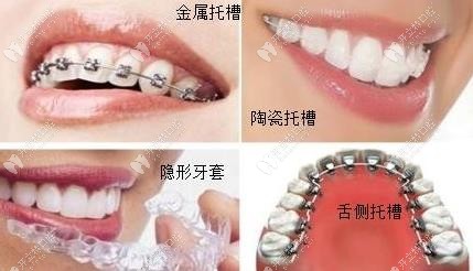 几款常见的牙齿矫正器