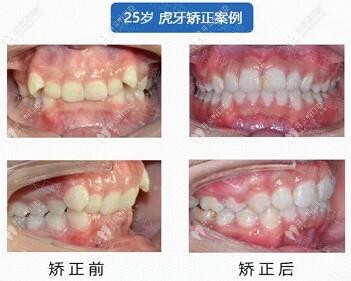 熊医生——虎牙矫正病例