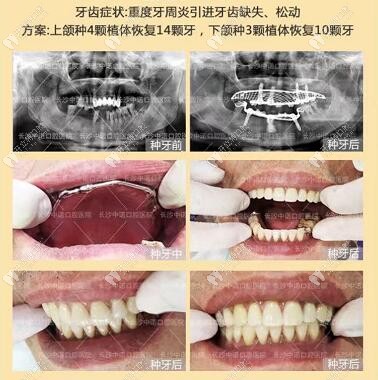 易继恩医生——全口立得用种牙病例