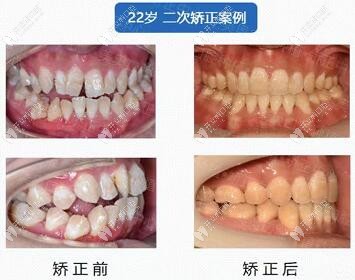 熊老师——22岁二次矫正效果对比图