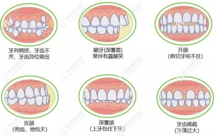 牙齿不齐的各种症状