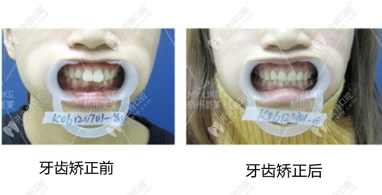 牙齿矫正前后图片