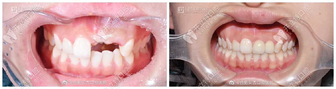 贝杰口腔种植牙修复病例