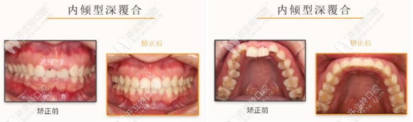 隐适美矫正深覆合对比图