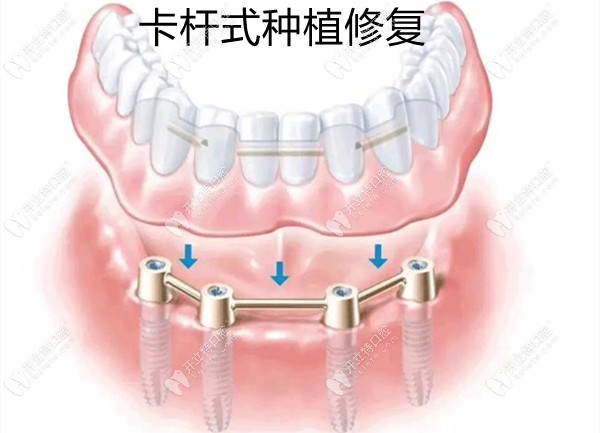 杆卡式全口种植修复