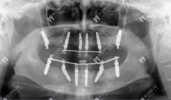 ALL-ON-6种植牙X线片