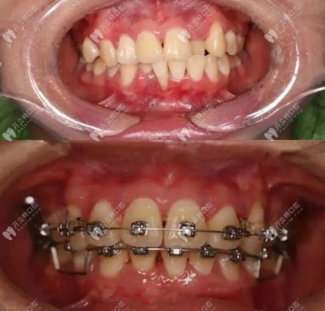 牙周差，PAOO植骨后矫正前后口内对比图
