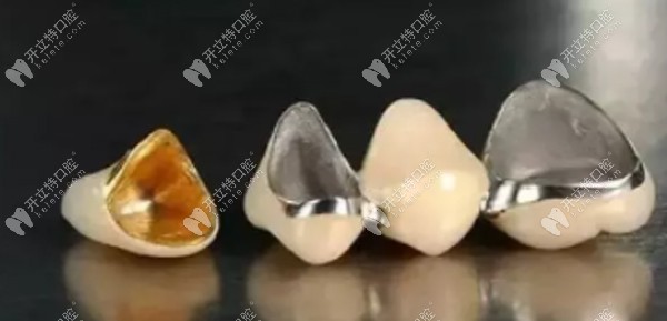 烤瓷牙需将牙齿磨掉1.5-2mm