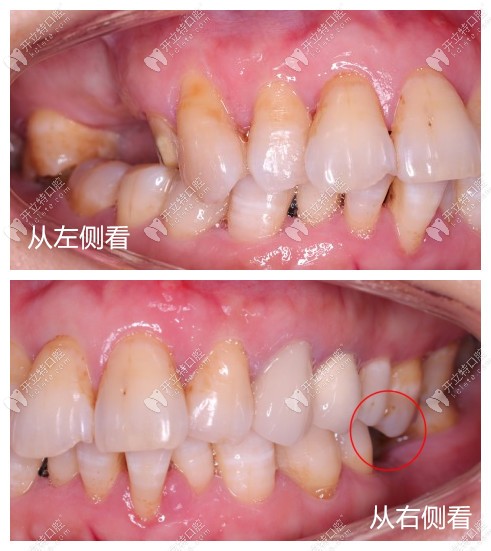 嘴巴闭合时牙齿状况