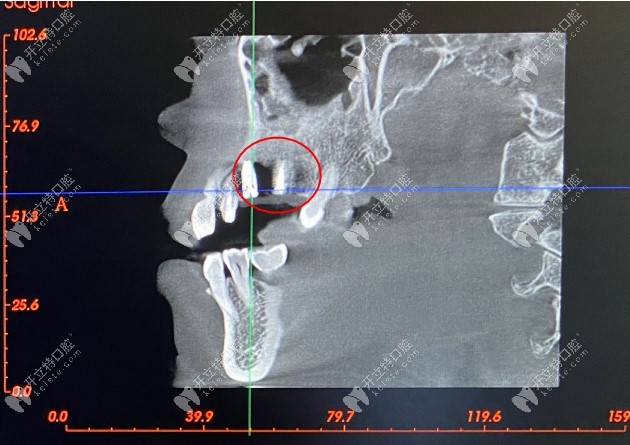 种牙后CT显示上颌右侧种植的两颗种植钉的情况