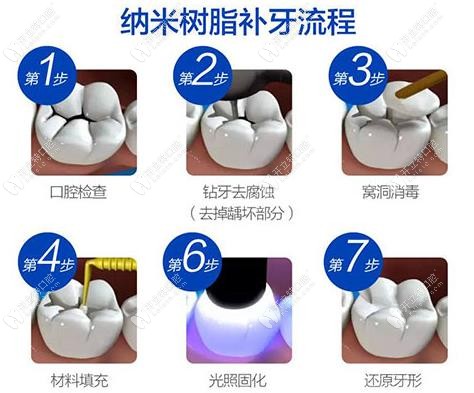 树脂补牙流程