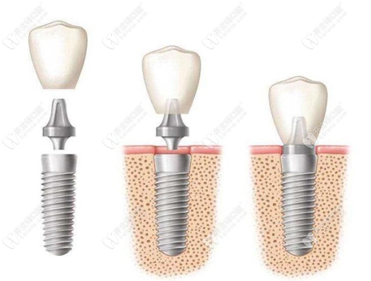 牙齿种植技术