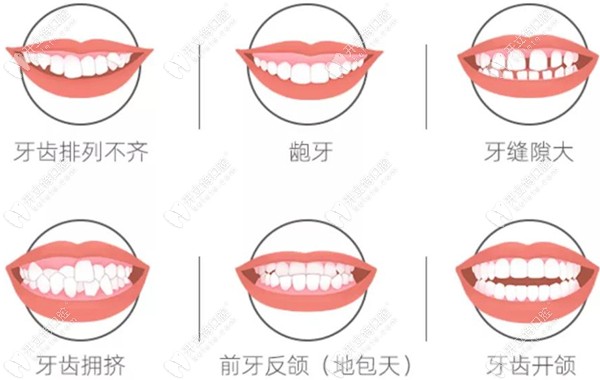 暑期来广州广大可以低价矫正牙齿,还可0元试戴隐形牙套哦