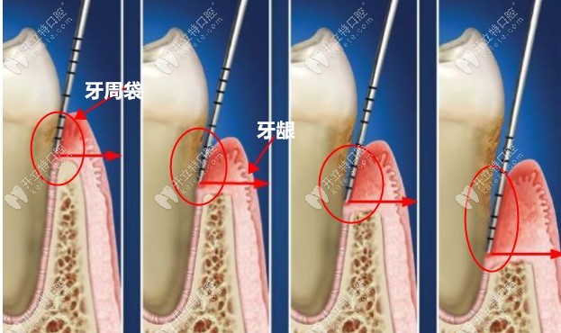 牙周袋和牙龈位置示意图