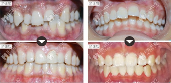 牙齿凌乱、排列不齐、单颗门牙外突矫正前后变化