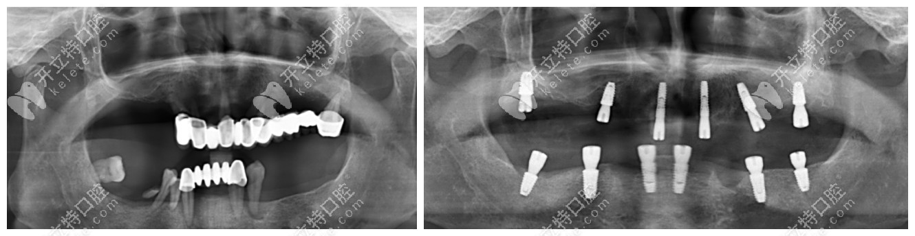 做即刻种植牙前后对比照