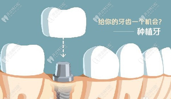 泸州牙博士一日得种植牙技术