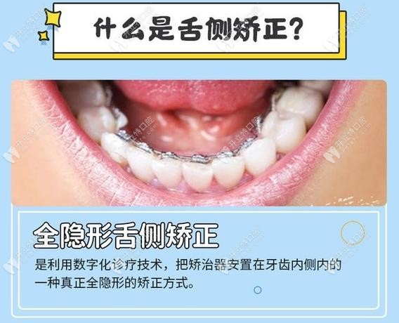 深圳舌侧隐形牙齿矫正的价格