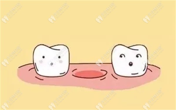 90后缺牙者在广州中家医的治疗