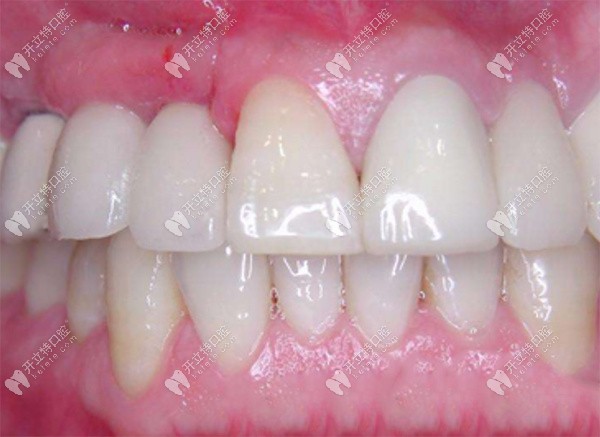 牙齿种植后的效果对比