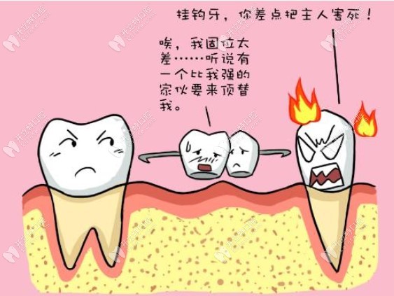 这次上场的就是固位力强的无挂钩活动义齿