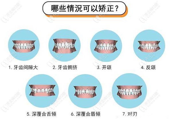 牙齿矫正的类型比较多