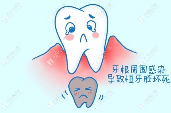 乳牙龋病不治会导致恒牙坏死