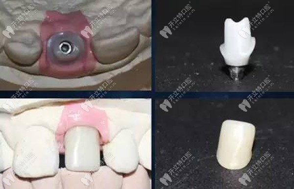 牙片屏障技术目前正在临床阶段