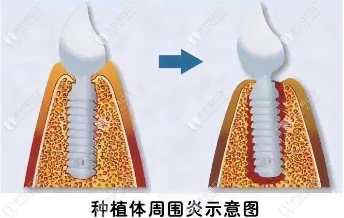 种植牙周围发炎