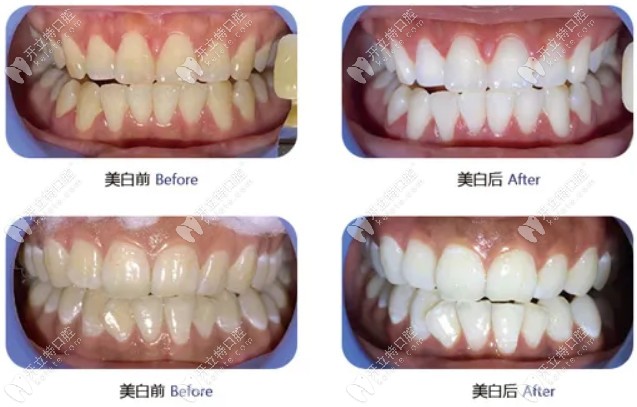修复医生尤乐平为顾客做牙齿美白后前后对比图