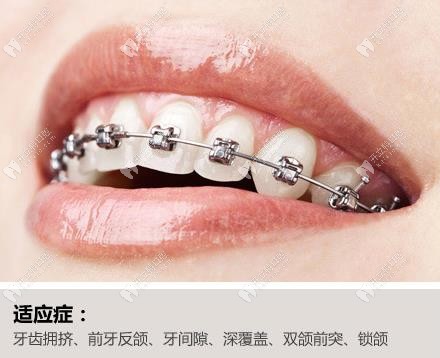 成都极光传统钢丝矫正牙套的优势