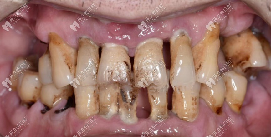 分享扬州贝恩口腔种植牙经典病例:Allon6即刻种植恢复全口牙