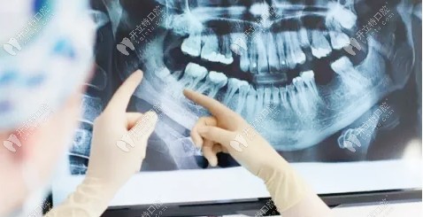 种牙术前进行3D分析