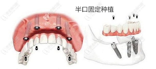 半口固定种植